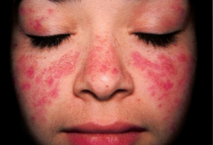 mắc bệnh Lupus ban đỏ 
