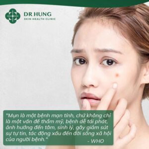 Mụn trứng cá là bệnh mạn tính cần được điều trị kịp thời