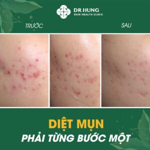 DIỆT MỤN PHẢI TỪNG BƯỚC MỘT