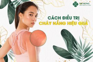 Cách điều trị cháy nắng