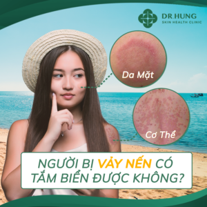 người bị vảy nến có tắm biển được không