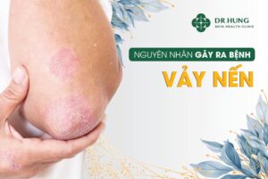 nguyên nhân gây vảy nến